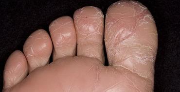 Шелушение кожи на ногах: причины зуда и шелушения ниже колен Шелушится и чешется стопа ноги
